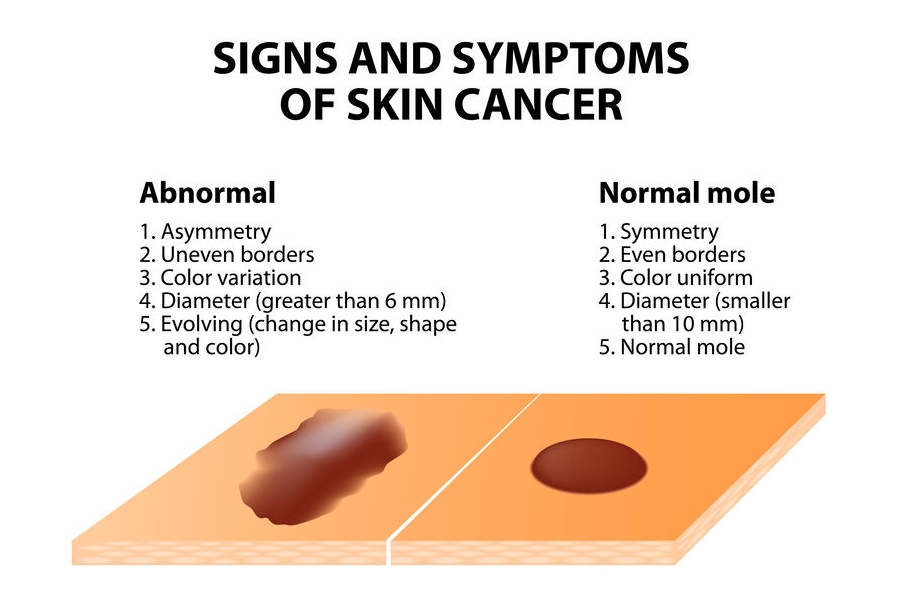黑色素細胞瘤