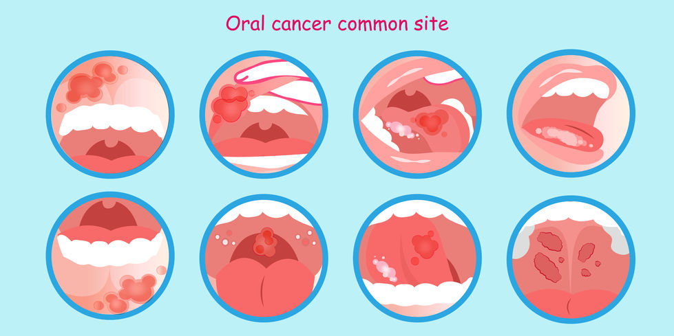 口腔癌常見發生位置