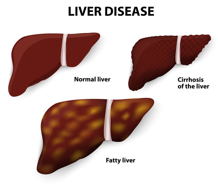 脂肪肝與肝硬化