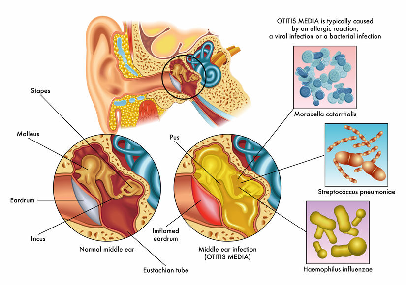 中耳炎常見細菌