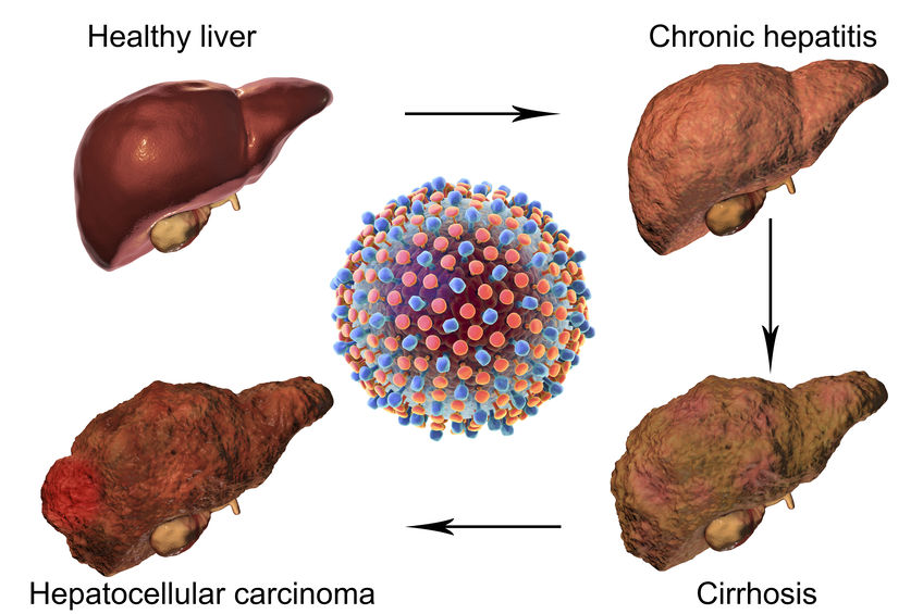病毒性肝炎的危害